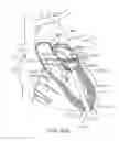 Fig. 33 - Transcatheter mitral valve prosthesis