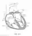 Fig. 37 - Transcatheter mitral valve prosthesis