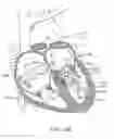 Fig. 40 - Transcatheter mitral valve prosthesis