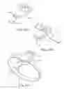 Fig. 12 - Cardiac support device delivery tool with release mechanism