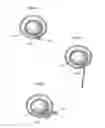 Fig. 06 - Implantable medical device for lubricating an artificial contacting surface