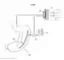 Fig. 15 - Implantable medical device for lubricating an artificial contacting surface