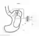 Fig. 18 - Implantable medical device for lubricating an artificial contacting surface