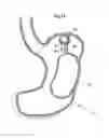 Fig. 19 - Implantable medical device for lubricating an artificial contacting surface