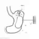 Fig. 20 - Implantable medical device for lubricating an artificial contacting surface