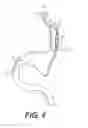 Fig. 03 - Gastrointestinal bypass devices and related methods of use