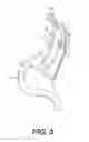 Fig. 04 - Gastrointestinal bypass devices and related methods of use