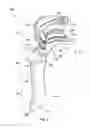 Fig. 03 - SPINAL SUPPORT DEVICE