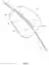 Fig. 08 - Apparatus and methods for treating excess intraocular fluid