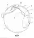 Fig. 07 - Apparatus for treating excess intraocular fluid