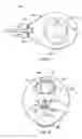 Fig. 06 - Intraocular drainage device