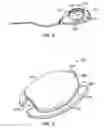 Fig. 07 - Intraocular drainage device