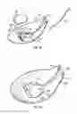 Fig. 09 - Intraocular drainage device