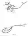 Fig. 10 - Intraocular drainage device