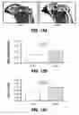 Fig. 22 - METHOD AND SYSTEM FOR PHYSICAL STIMULATION OF TISSUE