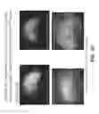 Fig. 35 - AAV-MEDIATED GENE THERAPY FOR NPHP5 LCA-CILIOPATHY