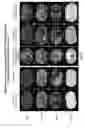 Fig. 12 - THERAPY OF MALIGNANT NEOPLASIAS
