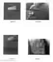 Fig. 07 - Hybrid material implant having variable porosity