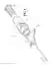 Fig. 02 - Medical devices, systems and methods utilizing permanent magnet and magnetizable feature