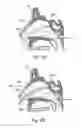 Fig. 04 - APPARATUS AND METHODS FOR DILATING AND MODIFYING OSTIA OF PARANASAL SINUSES AND OTHER INTRANASAL OR PARANASAL STRUCTURES