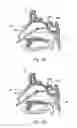 Fig. 07 - APPARATUS AND METHODS FOR DILATING AND MODIFYING OSTIA OF PARANASAL SINUSES AND OTHER INTRANASAL OR PARANASAL STRUCTURES