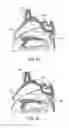 Fig. 09 - APPARATUS AND METHODS FOR DILATING AND MODIFYING OSTIA OF PARANASAL SINUSES AND OTHER INTRANASAL OR PARANASAL STRUCTURES
