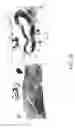 Fig. 49 - Methods and apparatuses for remodeling tissue of or adjacent to a body passage