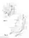 Fig. 02 - Side airbag energy management system