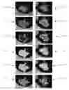 Fig. 01 - Computerized analysis of computed tomography (CT) imagery to quantify tumor infiltrating lymphocytes (TILs) in non-small cell lung cancer (NSCLC)