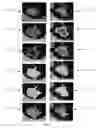 Fig. 04 - Computerized analysis of computed tomography (CT) imagery to quantify tumor infiltrating lymphocytes (TILs) in non-small cell lung cancer (NSCLC)