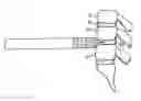 Fig. 01 - Spinal surgery distraction with an integrated retractor