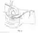 Fig. 07 - Uterine manipulator
