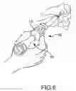Fig. 06 - Vertebral joint implants and delivery tools