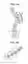 Fig. 04 - Methods for correction of spinal deformities