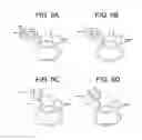 Fig. 06 - Methods for correction of spinal deformities