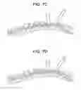 Fig. 08 - Methods for correction of spinal deformities