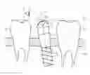 Fig. 01 - DETERMINING POSITION AND ORIENTATION OF A DENTAL IMPLANT