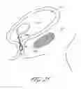 Fig. 32 - DELIVERY SYSTEM FOR INFLATABLE IMPLANT
