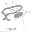 Fig. 35 - DELIVERY SYSTEM FOR INFLATABLE IMPLANT