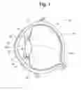 Fig. 02 - Intraocular lens and methods for implanting the same