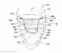 Fig. 01 - MITRAL PROLAPSE VALVE RESTRICTOR