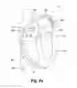 Fig. 06 - MITRAL PROLAPSE VALVE RESTRICTOR