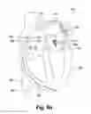 Fig. 07 - MITRAL PROLAPSE VALVE RESTRICTOR