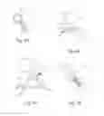 Fig. 20 - Vertebral implants and attachment assemblies