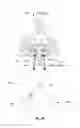 Fig. 23 - Systems for distracting uncinate joints
