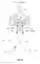 Fig. 23 - Medial to lateral uncinate joint stabilizer systems and methods