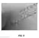 Fig. 05 - Bidirectional stent and method of use thereof