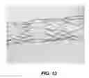 Fig. 13 - Bidirectional stent and method of use thereof