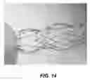 Fig. 14 - Bidirectional stent and method of use thereof
