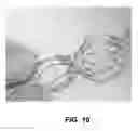 Fig. 16 - Bidirectional stent and method of use thereof